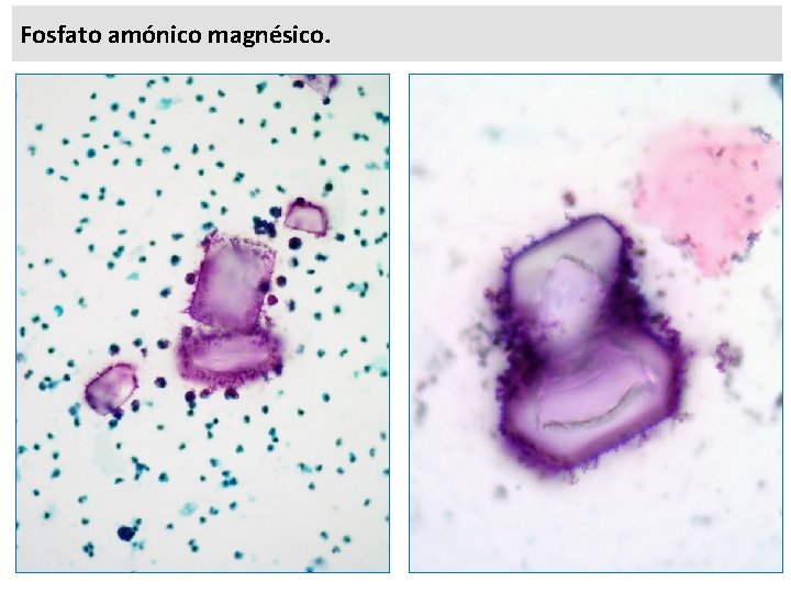 Fosfato amónico magnésico. 