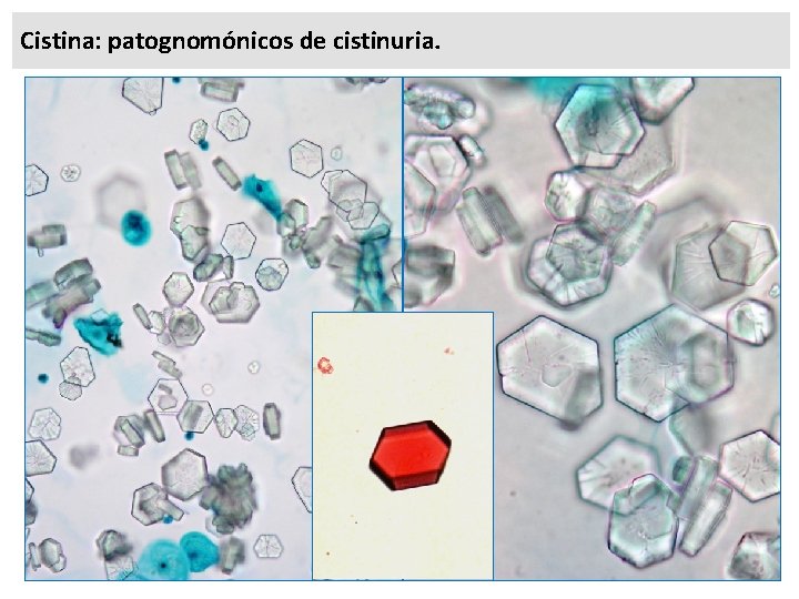 Cistina: patognomónicos de cistinuria. 