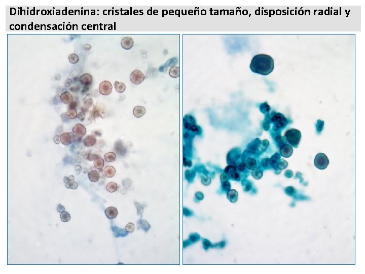 Dihidroxiadenina: cristales de pequeño tamaño, disposición radial y condensación central 