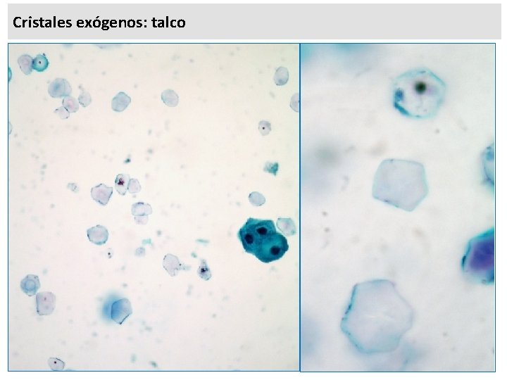 Cristales exógenos: talco 