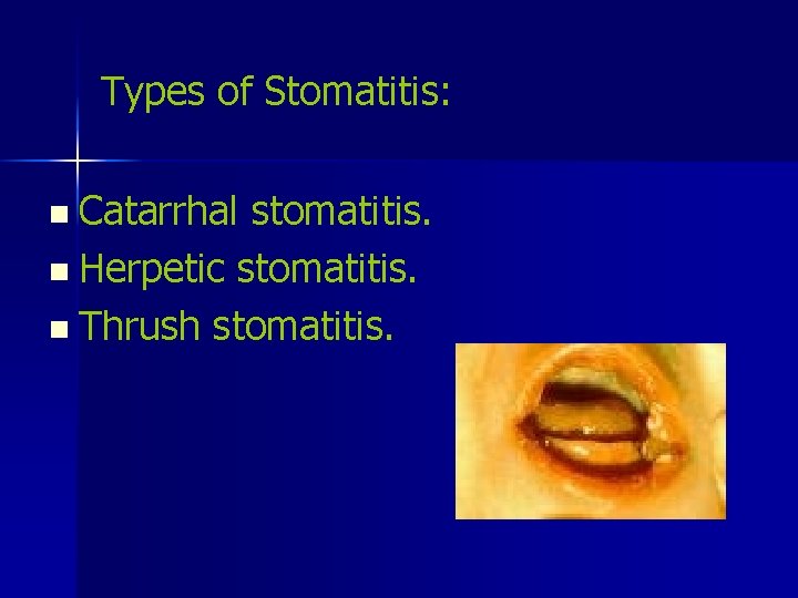 Types of Stomatitis: n Catarrhal stomatitis. n Herpetic stomatitis. n Thrush stomatitis. 