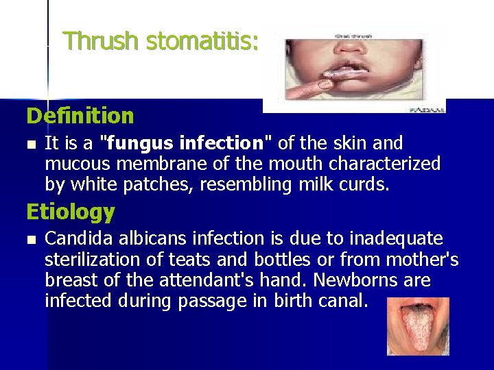 Thrush stomatitis: Definition n It is a "fungus infection" of the skin and mucous