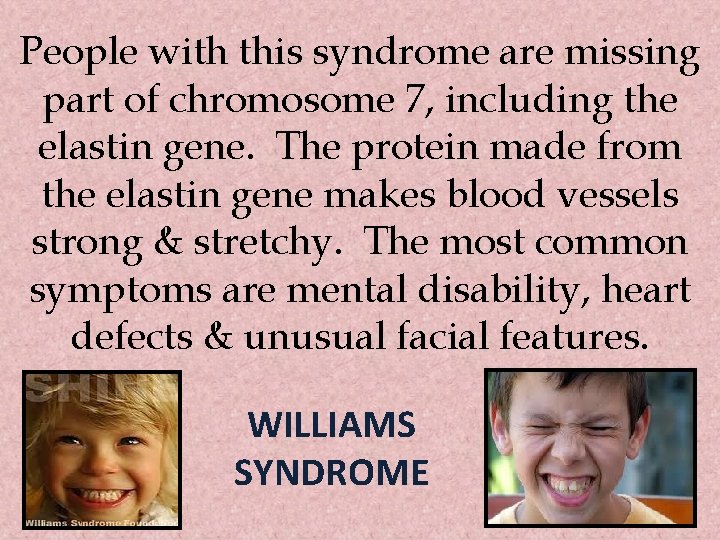 People with this syndrome are missing part of chromosome 7, including the elastin gene.