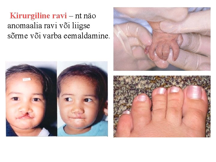 Kirurgiline ravi – nt näo anomaalia ravi või liigse sõrme või varba eemaldamine. Kirurgiline ravi – nt näo anomaalia ravi või liigse sõrme või varba eemaldamine.