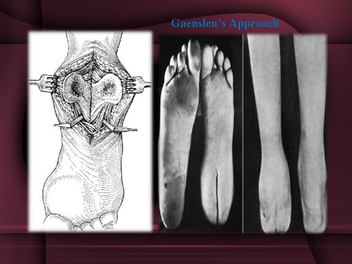 Gaenslen’s Approach 