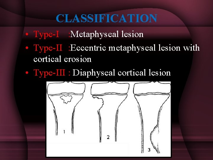 CLASSIFICATION • Type-I : Metaphyseal lesion • Type-II : Eccentric metaphyseal lesion with cortical