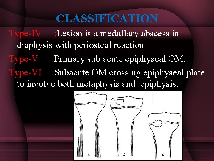 CLASSIFICATION Type-IV : Lesion is a medullary abscess in diaphysis with periosteal reaction Type-V