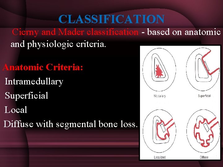 CLASSIFICATION Cierny and Mader classification - based on anatomic and physiologic criteria. Anatomic Criteria: