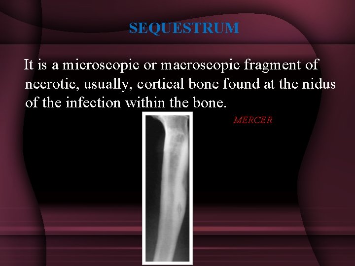 SEQUESTRUM It is a microscopic or macroscopic fragment of necrotic, usually, cortical bone found