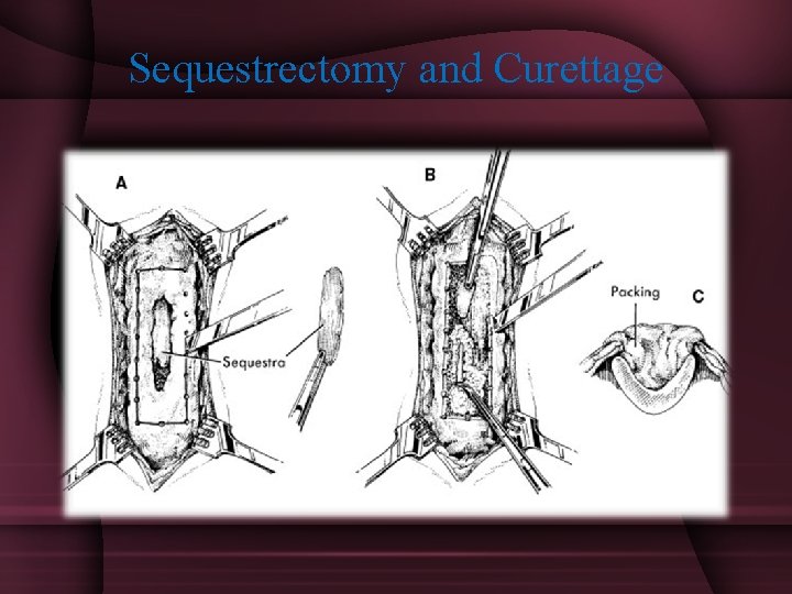 Sequestrectomy and Curettage 