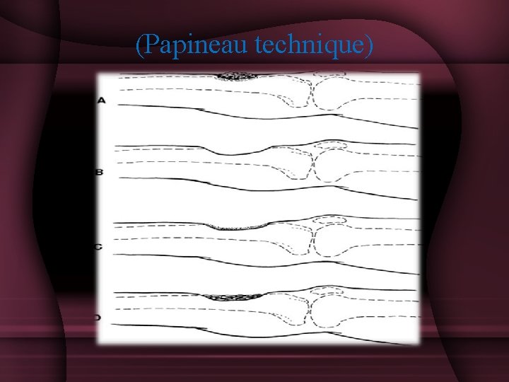 (Papineau technique) 