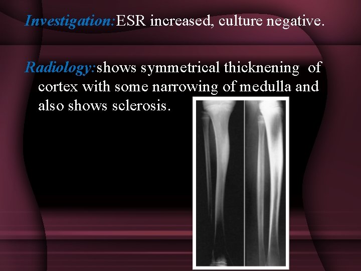 Investigation: ESR increased, culture negative. Radiology: shows symmetrical thicknening of cortex with some narrowing