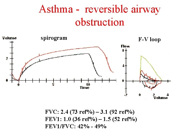 Asthma - reversible airway obstruction spirogram FVC: 2. 4 (73 ref%) – 3. 1