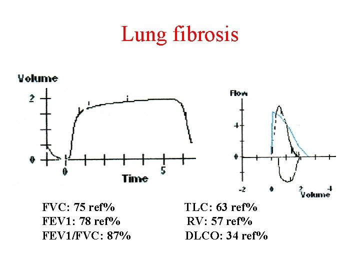 Lung fibrosis FVC: 75 ref% FEV 1: 78 ref% FEV 1/FVC: 87% TLC: 63