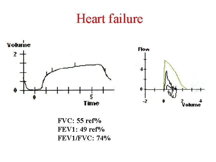 Heart failure FVC: 55 ref% FEV 1: 49 ref% FEV 1/FVC: 74% 