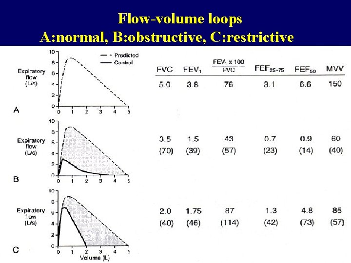 Flow-volume loops A: normal, B: obstructive, C: restrictive 