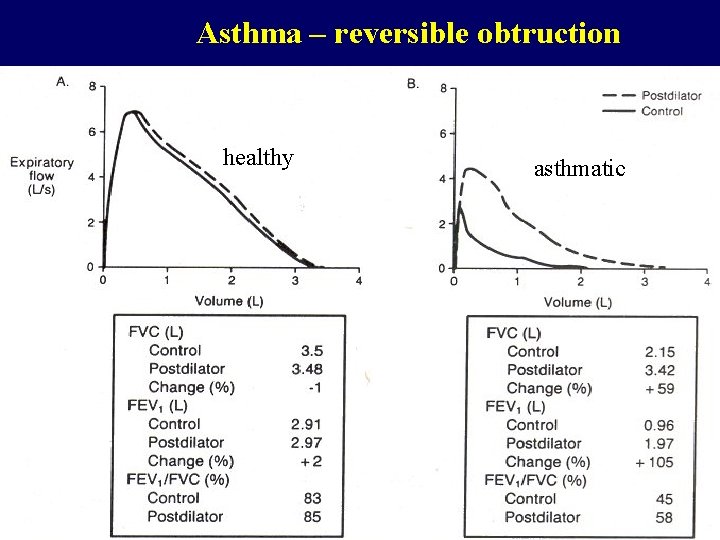 Asthma – reversible obtruction healthy asthmatic 