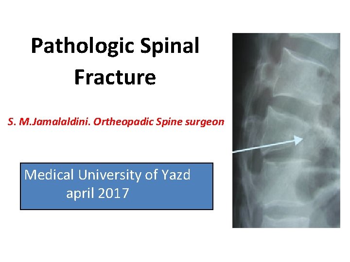 Pathologic Spinal Fracture S. M. Jamalaldini. Ortheopadic Spine surgeon Medical University of Yazd april