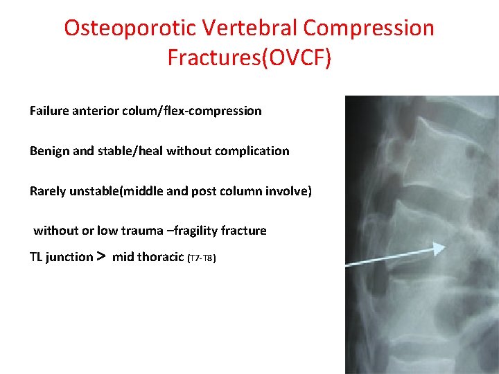 Osteoporotic Vertebral Compression Fractures(OVCF) Failure anterior colum/flex-compression Benign and stable/heal without complication Rarely unstable(middle