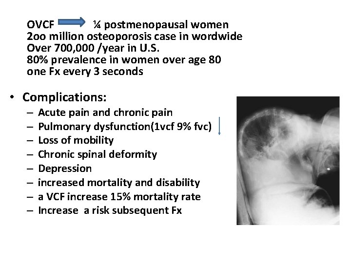 OVCF ¼ postmenopausal women 2 oo million osteoporosis case in wordwide Over 700, 000