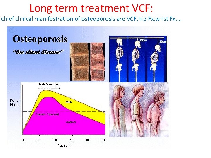 Long term treatment VCF: chief clinical manifestration of osteoporosis are VCF, hip Fx, wrist