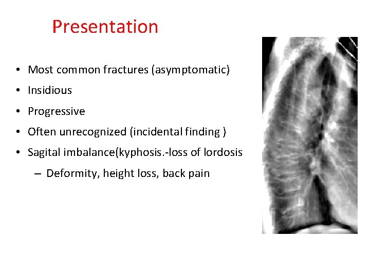 Presentation • Most common fractures (asymptomatic) • Insidious • Progressive • Often unrecognized (incidental
