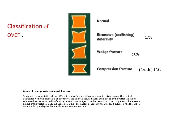 Classification of OVCF : 17% 50% (Crush ) 13% Types of osteoporotic vertebral fracture
