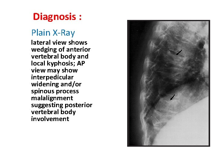 Diagnosis : Plain X-Ray lateral view shows wedging of anterior vertebral body and local