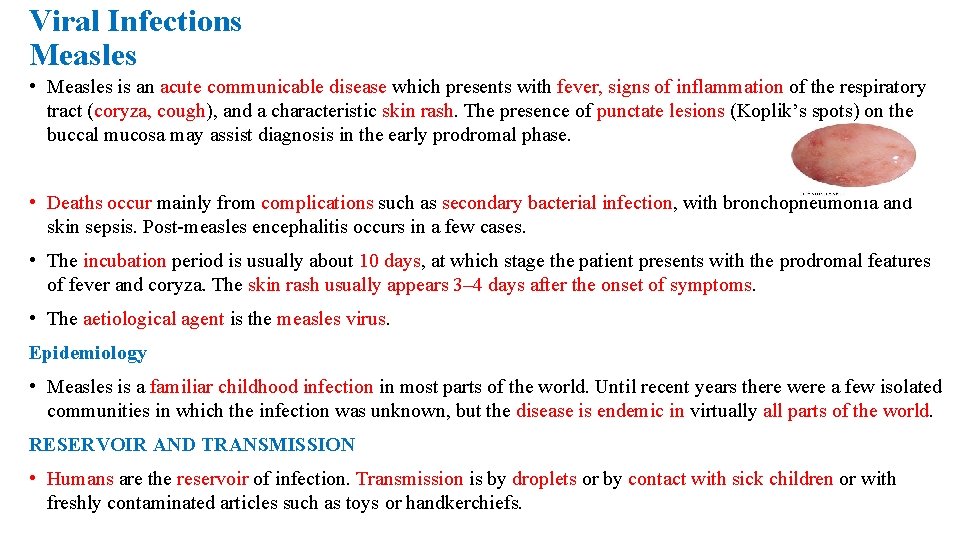 Viral Infections Measles • Measles is an acute communicable disease which presents with fever,