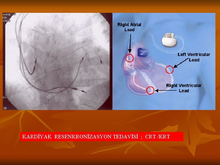 KARDİYAK RESENKRONİZASYON TEDAVİSİ ; CRT /KRT 