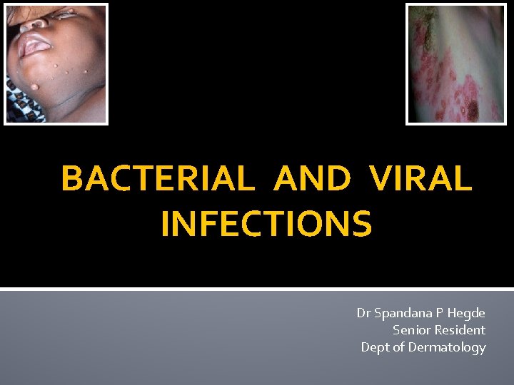 BACTERIAL AND VIRAL INFECTIONS Dr Spandana P Hegde Senior Resident Dept of Dermatology 