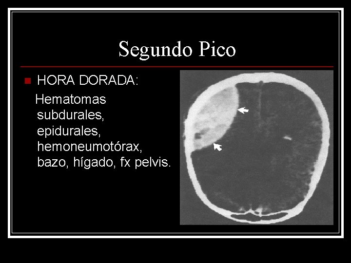 Segundo Pico n HORA DORADA: Hematomas subdurales, epidurales, hemoneumotórax, bazo, hígado, fx pelvis. 
