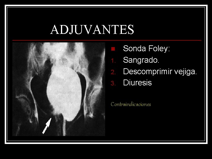 ADJUVANTES n 1. 2. 3. Sonda Foley: Sangrado. Descomprimir vejiga. Diuresis Contraindicaciones 