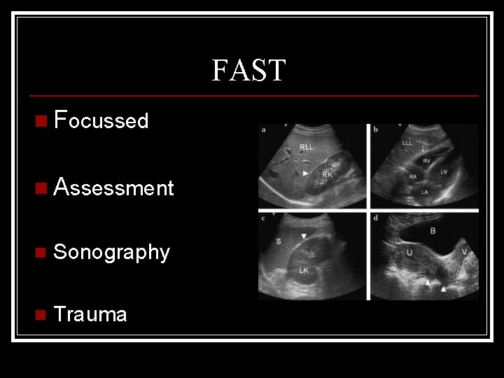 FAST n Focussed n Assessment n Sonography n Trauma 