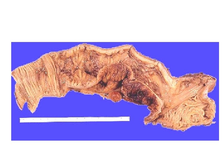 Anatomia patologica Cancro del colon 10 