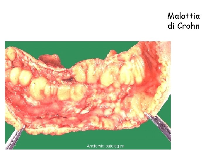 Malattia di Crohn Anatomia patologica Cancro del colon 11 