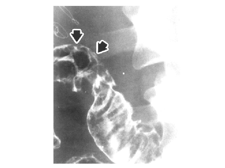 Anatomia patologica Cancro del colon 13 