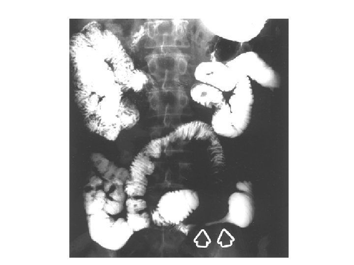 Anatomia patologica Cancro del colon 14 