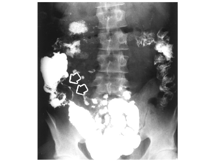 Anatomia patologica Cancro del colon 15 
