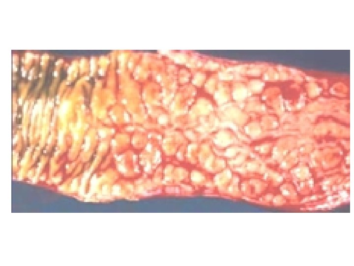 Anatomia patologica Cancro del colon 17 