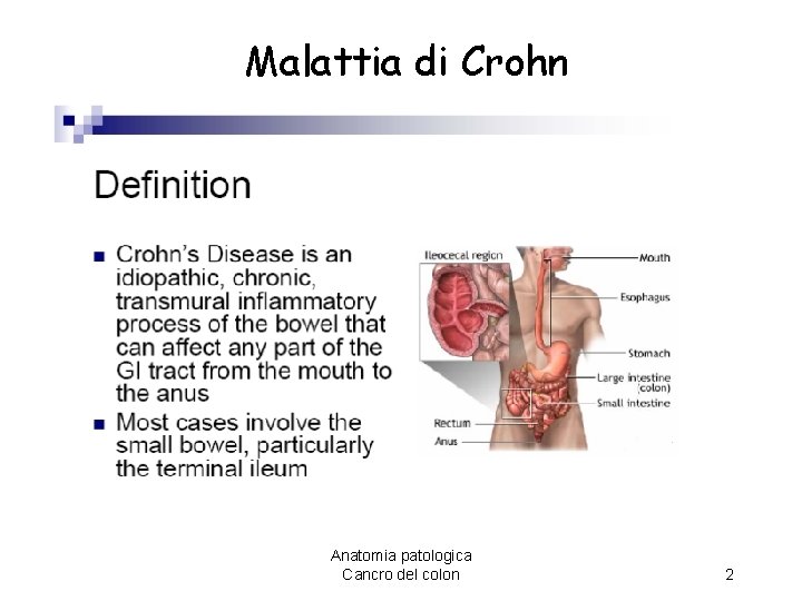 Malattia di Crohn Anatomia patologica Cancro del colon 2 