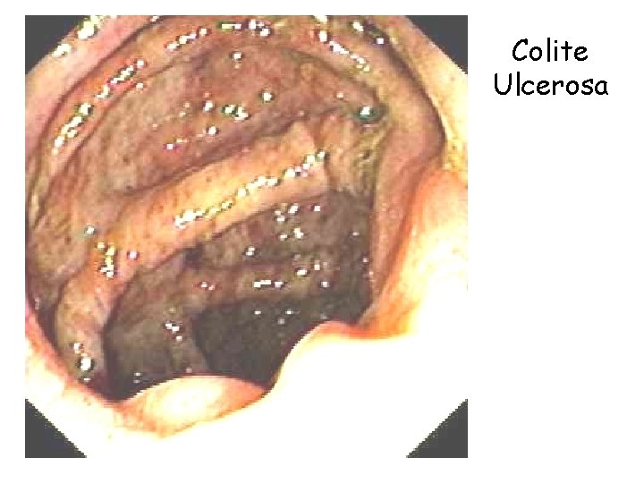 Colite Ulcerosa Anatomia patologica Cancro del colon 25 