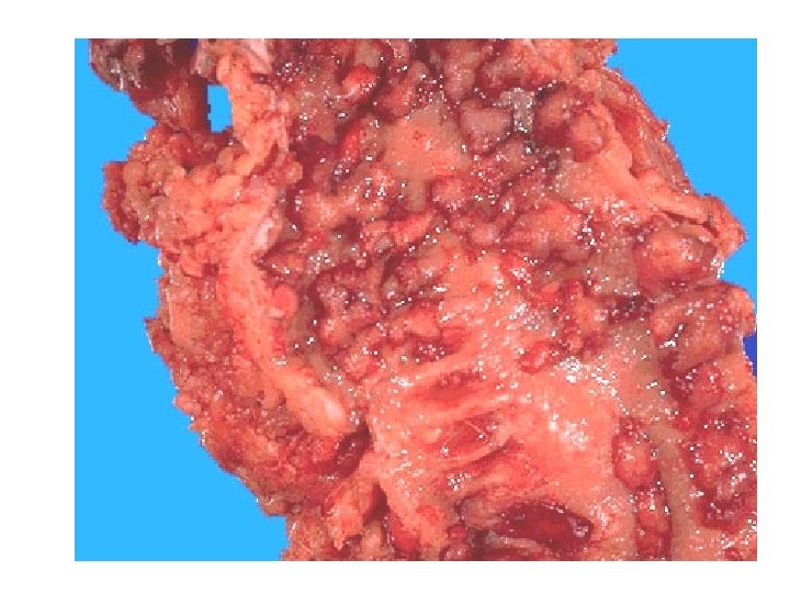 Anatomia patologica Cancro del colon 28 