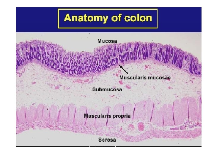 Anatomia patologica Cancro del colon 31 