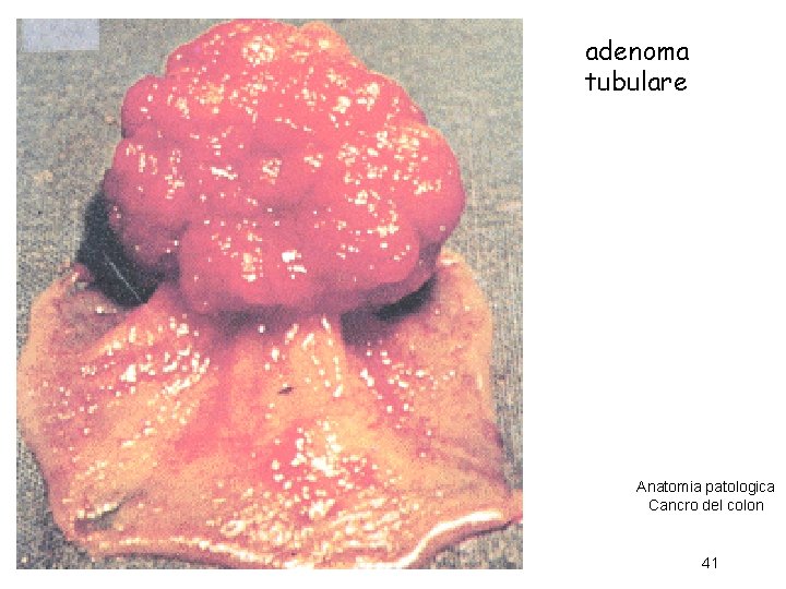 adenoma tubulare Anatomia patologica Cancro del colon 41 