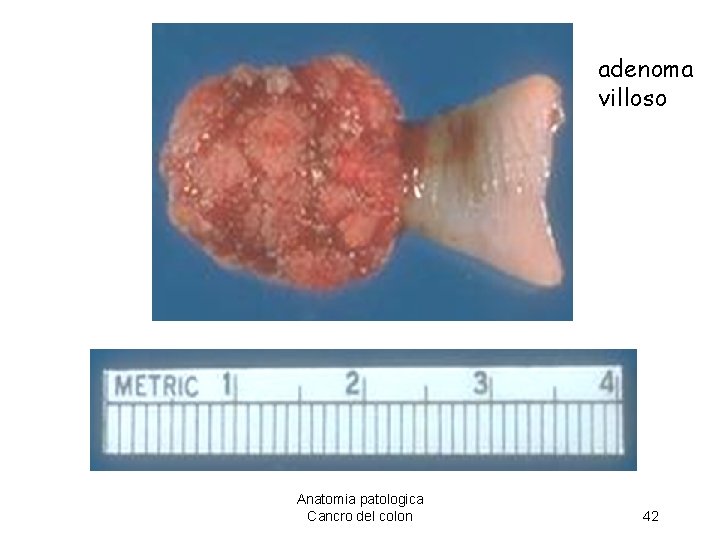 adenoma villoso Anatomia patologica Cancro del colon 42 