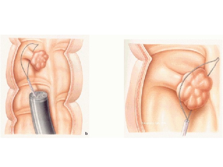 POLIPECTOMIA ENDOSCOPICA K. Kremer e Coll. , 1996 Anatomia patologica Cancro del colon 50