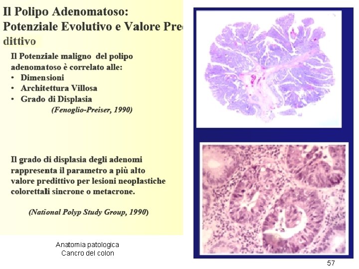 Anatomia patologica Cancro del colon 57 