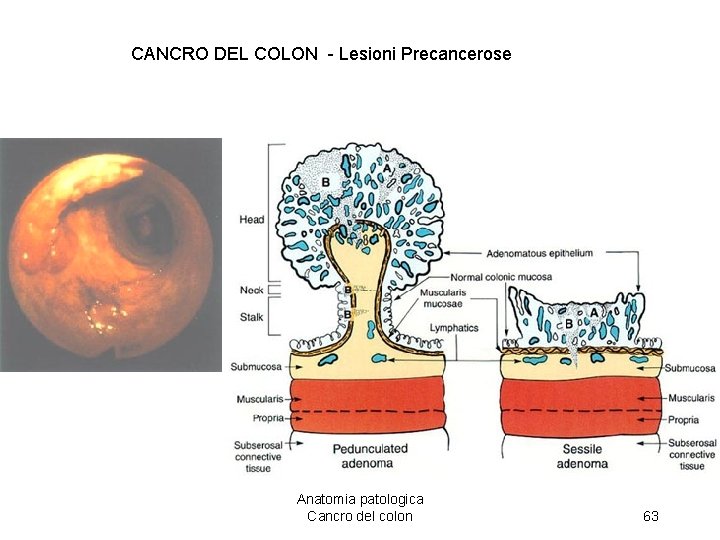 Ca. CANCRO DEL COLON - Lesioni Precancerose Anatomia patologica Cancro del colon 63 