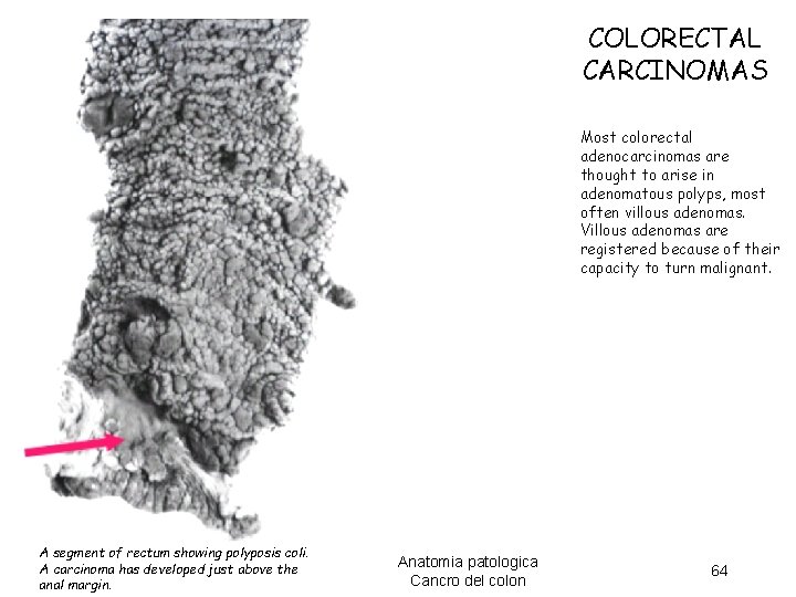 COLORECTAL CARCINOMAS Most colorectal adenocarcinomas are thought to arise in adenomatous polyps, most often